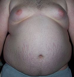 Typisches Erscheinungsbild bei Fettleibigkeit