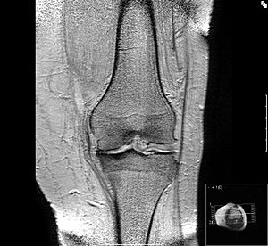 Mediale Gonarthrose NMR-Darstellung eines arthrotischen Kniegelenkes. Deutlich zu sehen sind die Osteophyten im medianen (mittigen) und lateralen Bereich des Gelenkspaltes und der Verschleiß oder Abrieb der Knorpelschicht im linken Bereich des Bildes. Der Knochen des Schienbeinkopfes im mittigen Bereich ist verdichtet, eine Reaktion auf den vermehrten mechanischen Stress. Die Knorpelschicht hat ihre Dämpfungsfunktion eingebüßt.