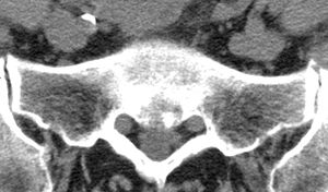 CT-Aufnahme einer Arthrose am Ileosakralgelenk (Kreuz-Darmbeingelenk)