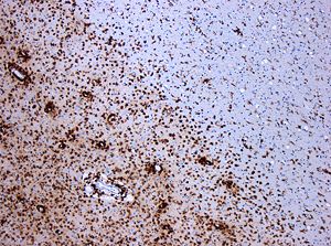 Demyelinisierung bei Multipler Sklerose.In der immunhistochemischen Färbung für CD68 markieren sich (braungefärbt) zahlreiche Makrophagen im Bereich der Läsion. Originalvergrößerung 1:100