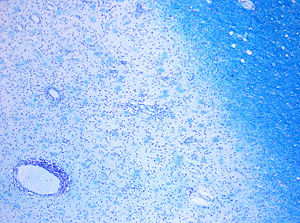 Demyelinisierung bei Multipler Sklerose.In der Markscheidenfärbung nach Klüver-Barrera ist eine deutliche Abblassung der (hier blau gefärbten) Markscheiden im Bereich der Läsion erkennbar (Originalvergrößerung 1:100).