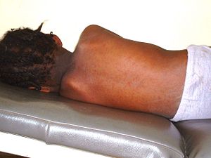 Masern-Ausschlag bei einem nigerianischen Mädchen. Der Großteil der weltweit auftretenden Krankheitsfälle betrifft den afrikanischen Kontinent.