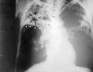 Röntgenbild der Lungen bei fortgeschrittener Lungentuberkulose mit beidseitigen Infiltraten (weiße Dreiecke) und einer Kaverne (schwarze Pfeile) im rechten Oberlappen