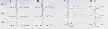 Belastungs-EKG eines Patienten mit koronarer Herzkrankheit: Senkung der ST-Strecke (Pfeil) ab 100  WattA in RuheB bei 75  WattC bei 100  WattD bei 125  Watt