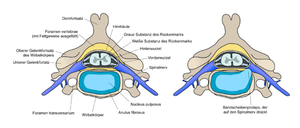 Links: Querschnitt durch die Strukturen der Halswirbelsäule. Rechts: Beim Bandscheibenvorfall tritt ein Teil des Nucleus pulposus durch den Anulus fibrosus und verursacht durch Druck auf den Spinalnerv Beschwerden