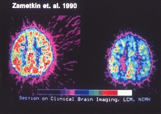 Links: Gehirnaktivität einer Person ohne ADS. Rechts: Aktivität einer Person mit ADS.