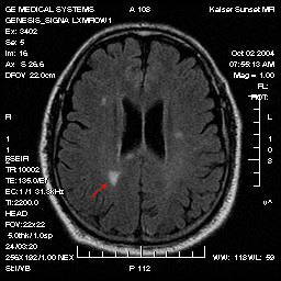 Magnetresonanztomographie bei einem Patienten mit Multipler Sklerose.Zu sehen sind multiple Entmarkungsherde im Marklager des Großhirns, einer davon mit Pfeil markiert.