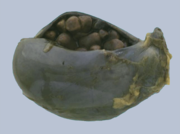 Gallenblase mit Gallensteinen