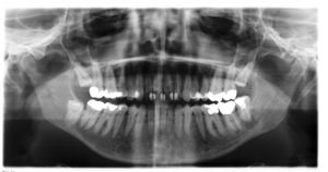 menschliches Gebiss mit 32 Zähnen (Röntgenbild); bis auf Zahn 38 (im Bild rechts unten) sind die Weisheitszähne noch nicht durchgebrochen
