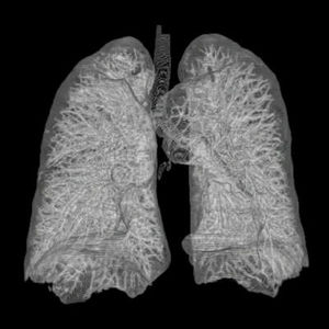 3D-Rekonstruktion menschlicher Lunge aus CT-Bildern